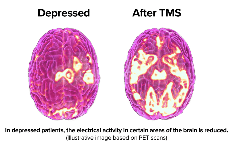 What is TMS?